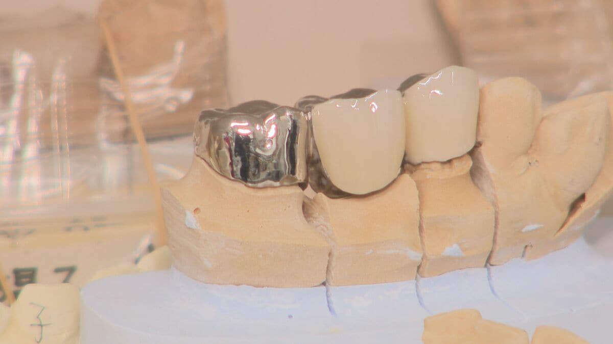 銀歯1本で5000円赤字？“金パラ”価格高騰に「チェックしないと怖い」歯医者でおきている異変とは | TBS NEWS DIG (2ページ)