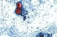 激しい下痢を引き起こす寄生虫感染、米中西部やニューヨークで拡大| TBS CROSS DIG with Bloomberg