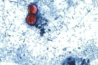 激しい下痢を引き起こす寄生虫感染、米中西部やニューヨークで拡大| TBS CROSS DIG with Bloomberg