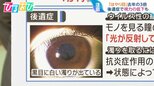 「はやり目」去年の3倍 視力低下の可能性も…“目ヤニ”“充血” 眼科に行く目安は?【ひるおび】|TBS NEWS DIG
