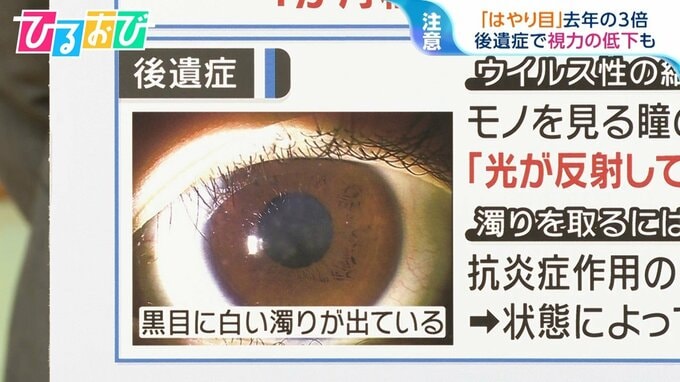 「はやり目」去年の3倍　視力低下の可能性も…“目ヤニ”“充血” 眼科に行く目安は？【ひるおび】|TBS NEWS DIG