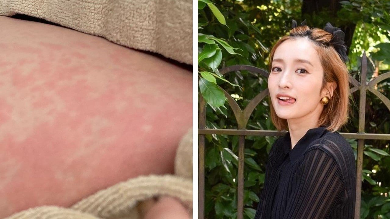 梅田彩佳    唇 【元AKB48梅田彩佳】原因不明 じんましん写真投稿「全身。顔にも。熱も出てきて。」 | TBS NEWS DIG