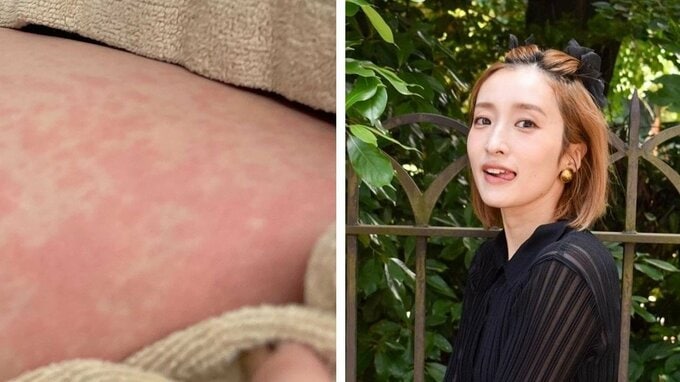 【元AKB48梅田彩佳】原因不明　じんましん写真投稿「全身。顔にも。熱も出てきて。」|TBS NEWS DIG