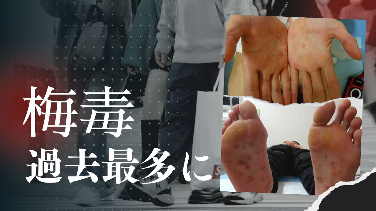 薄れる ヤリモク の抵抗感 梅毒 感染爆発の背景か やるために出会う 症状ないまま感染も Tbs News Dig 3ページ 薄れる ヤリモク の抵抗感 梅毒 感染爆発の背景か やるために出会う 症状ないまま感染も Tbs News Dig 3ページ