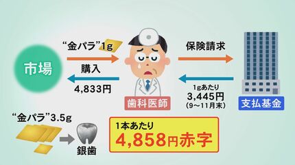 銀歯1本で5000円赤字？“金パラ”価格高騰に「チェックしないと怖い