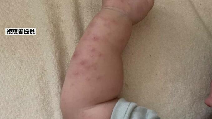 手足口病が富山県でも５年ぶりに警報レベル超　全国的に５月下旬から増加傾向　おむつ交換や食事前などこまめな手洗いを　|　富山のニュース｜天気・防災｜チューリップテレビ