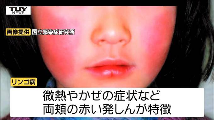 感染症「リンゴ病」の患者数が増加　県内では6年ぶりの警報レベル（山形）　|　山形のニュース│TUYテレビユー山形