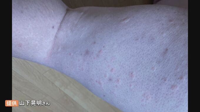 熱めの風呂に入ったら発疹が…「温熱じんましん」寒い季節注意　「死ぬまで付き合うしかないのかな…」10年以上悩まされる人も　対策は？|TBS NEWS DIG