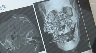 「破傷風は死ぬ確率が高い」“軽傷”でも命の危険…手足から感染症にかかるリスクも クマ治療の医師が警鐘　　|　富山のニュース｜天気・防災｜チューリップテレビ