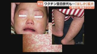 はしか感染拡大…子どもだけじゃない!ワクチン空白世代は注意 症状が軽く気付きにくい「修飾麻疹」も | 富山のニュース|天気・防災|チューリップテレビ
