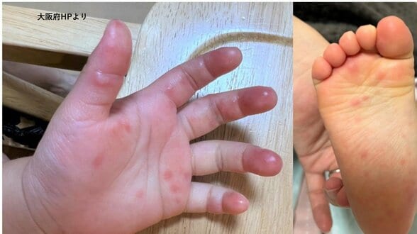 【手足口病に注意】感染者が前の週から63％増！おむつ交換後にはしっかり手洗いを　暑くなる季節…O157など腸管出血性大腸菌感染症にも注意を　|　MBSニュース | 関西の最新ニュースを分かりやすく。