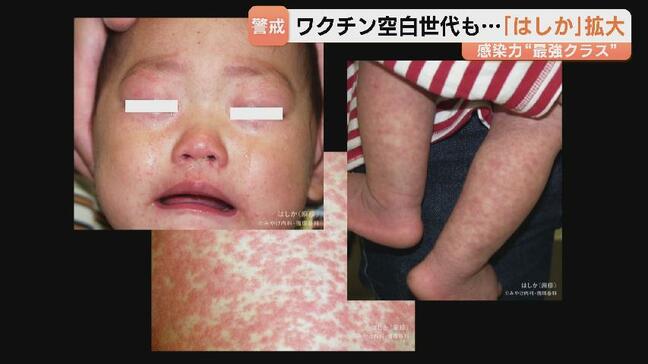 はしか感染拡大…子どもだけじゃない!ワクチン空白世代は注意 症状が軽く気付きにくい「修飾麻疹」も|TBS NEWS DIG