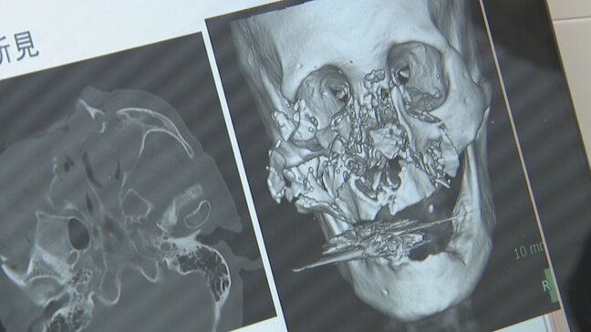 「破傷風は死ぬ確率が高い」“軽傷”でも命の危険…手足から感染症にかかるリスクも クマ治療の医師が警鐘　|TBS NEWS DIG