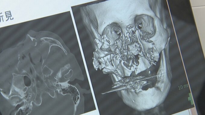 「破傷風は死ぬ確率が高い」“軽傷”でも命の危険…手足から感染症にかかるリスクも クマ治療の医師が警鐘　　|　富山のニュース｜天気・防災｜チューリップテレビ