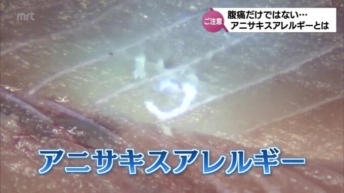 「その先、アニサキスアレルギーになると魚が食べられなくなる」腹痛だけじゃないアニサキスの恐ろしさ|TBS NEWS DIG