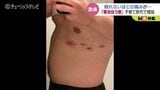 帯状ほう疹で顔に水ぶくれ激痛のあと強烈なかゆみも…治療法と予防ワクチンの副反応と値段|TBS NEWS DIG