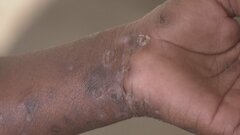 エムポックス「クレード1b」イギリスで感染初確認　コンゴ民主共和国を中心に感染広がる新タイプ| TBS CROSS DIG with Bloomberg