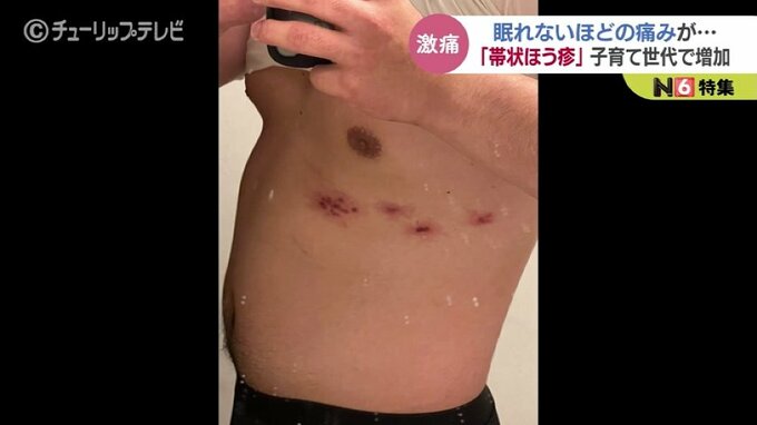 帯状ほう疹で顔に水ぶくれ激痛のあと強烈なかゆみも…治療法と予防ワクチンの副反応と値段|TBS NEWS DIG
