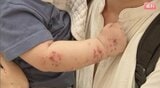 【手足口病】前週の約2倍に増加…患者の約8割が2歳以下の乳幼児…長野市23.8人で最多、諏訪12.33人、飯田11人…食事前の手洗いや咳エチケットなど対策呼びかけ | SBC NEWS | 長野のニュース | SBC信越放送