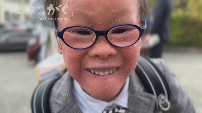 30万人に1人とされる難病と闘う男の子 3歳からの5年間を記録したドキュメンタリー ｢がんばろう。がく～30万分の1の運命｣ ギャラクシー賞受賞 CBCテレビ制作|TBS NEWS DIG
