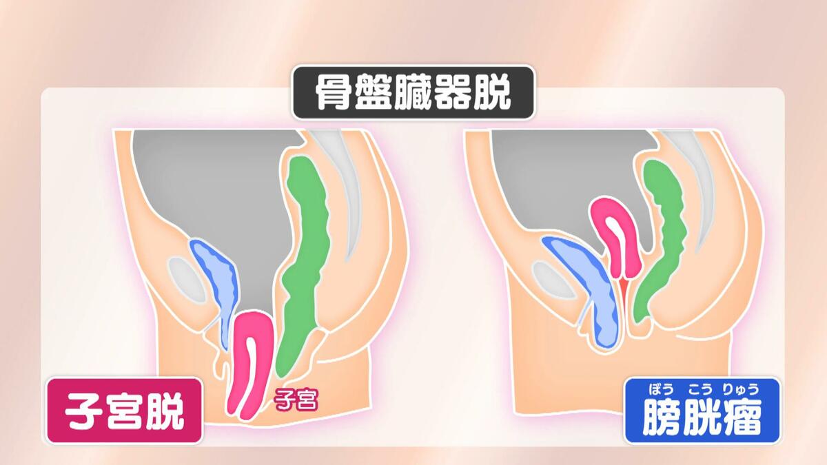 二次元 子宫  脱出 