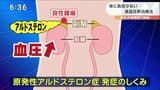「外科的手術をしなくて済む」二次性高血圧の新治療法“特殊な針”とは?|TBS NEWS DIG