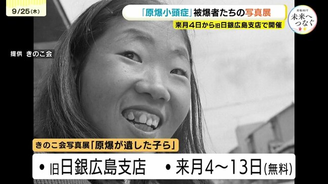 母親の胎内で被爆した「原爆小頭症」被爆者たち　貴重な日常を写した写真展　10月４日～13日まで広島市内で開催　本人と家族の会「きのこ会」主催|TBS NEWS DIG