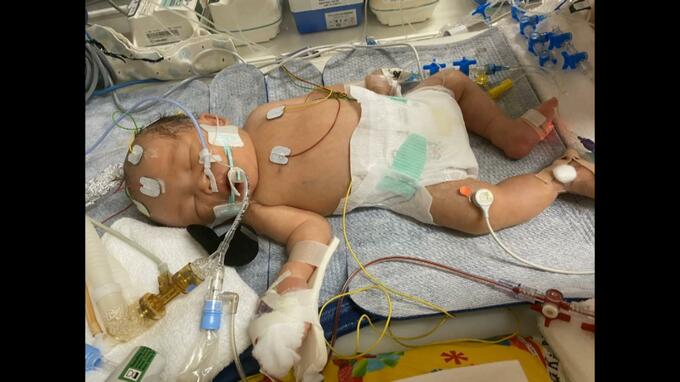 「息子の全てを奪った…」逆子の手術後に胎児に「脳障害」医療ミスで３歳のわが子は『全介助』歩くことしゃべることもできず…栄養は『胃ろう』母親の苦しい胸中「逃げるかのように病院を辞め許せない」|TBS NEWS DIG