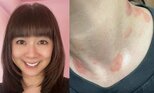 【 白石まるみ 】『多型滲出性紅斑』発症を報告「首の周りとかなんとなく痒くて、今朝、鏡見てびっくり!!」「なんじゃこりゃー!!」|TBS NEWS DIG