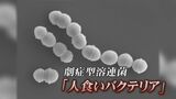 致死率30％“人食いバクテリア” 地方でも感染拡大傾向　切り傷、擦り傷から侵入　劇症型溶血性レンサ球菌　富山　|　富山のニュース｜天気・防災｜チューリップテレビ