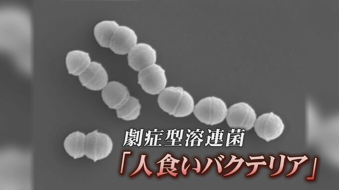 致死率30％“人食いバクテリア” 患者数過去最多に、地方でも感染拡大傾向　切り傷、擦り傷から侵入「劇症型溶連菌」　|　富山のニュース｜天気・防災｜チューリップテレビ