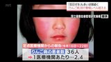 子どもに多い感染症「りんご病」　宮崎県内で14年ぶりに流行警報レベル超える　「百日ぜき」の患者数も過去最多に|TBS NEWS DIG