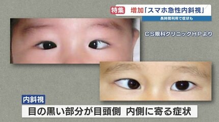 スマホ急性内斜視」の子どもが急増 スマホの利用頻度が影響か