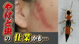 かぶれ、やけどのような炎症「やけど虫」の仕業かも　夏に活発化、日本全土に生息し触るだけで有毒成分が…もし触ってしまったら　|　富山のニュース｜天気・防災｜チューリップテレビ