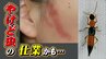かぶれ、やけどのような炎症「やけど虫」の仕業かも　夏に活発化、日本全土に生息し触るだけで有毒成分が…もし触ってしまったら　|　富山のニュース｜天気・防災｜チューリップテレビ