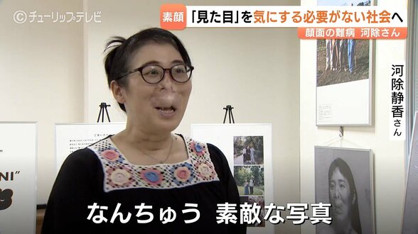 見た目は「気にする必要がない」と願うも普段はマスク姿…手術40回以上の河除静香さんが素顔で立った写真展　富山・南砺市　|　富山のニュース｜天気・防災｜チューリップテレビ