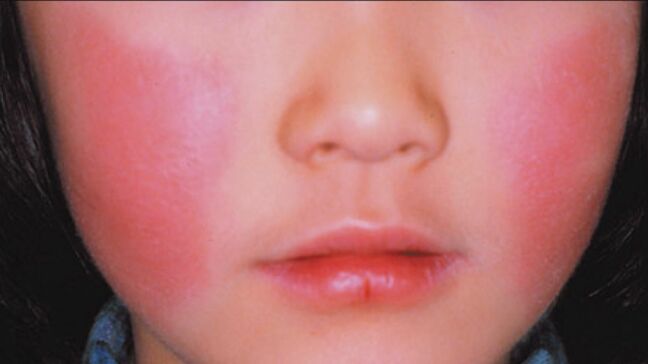 「リンゴ病」感染拡大　患者数が前週より1.2倍以上に増加　大分|TBS NEWS DIG