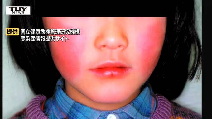 おさまらない“リンゴ病”患者数　山形県内で猛威ふるい32週連続の警報レベルに|TBS NEWS DIG