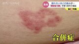 顔に帯状ほう疹出た女性「地獄だった。痛くて死んだ方が…」1年経っても続く症状とは|TBS NEWS DIG