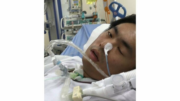 【 両肺移植 】音楽ユニット『モトブル』松本さん「移植の前と後の想いは繋がっていて感謝の日々続く」　4月中にダウン症ダンサー・Yutoさんを歌った楽曲リリースも|TBS NEWS DIG