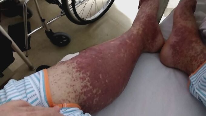 人気の牛骨白湯ラーメン店が突然臨時休業　足が腫れあがり、全身に激痛…店主を襲った「IgA血管炎」とは？|TBS NEWS DIG