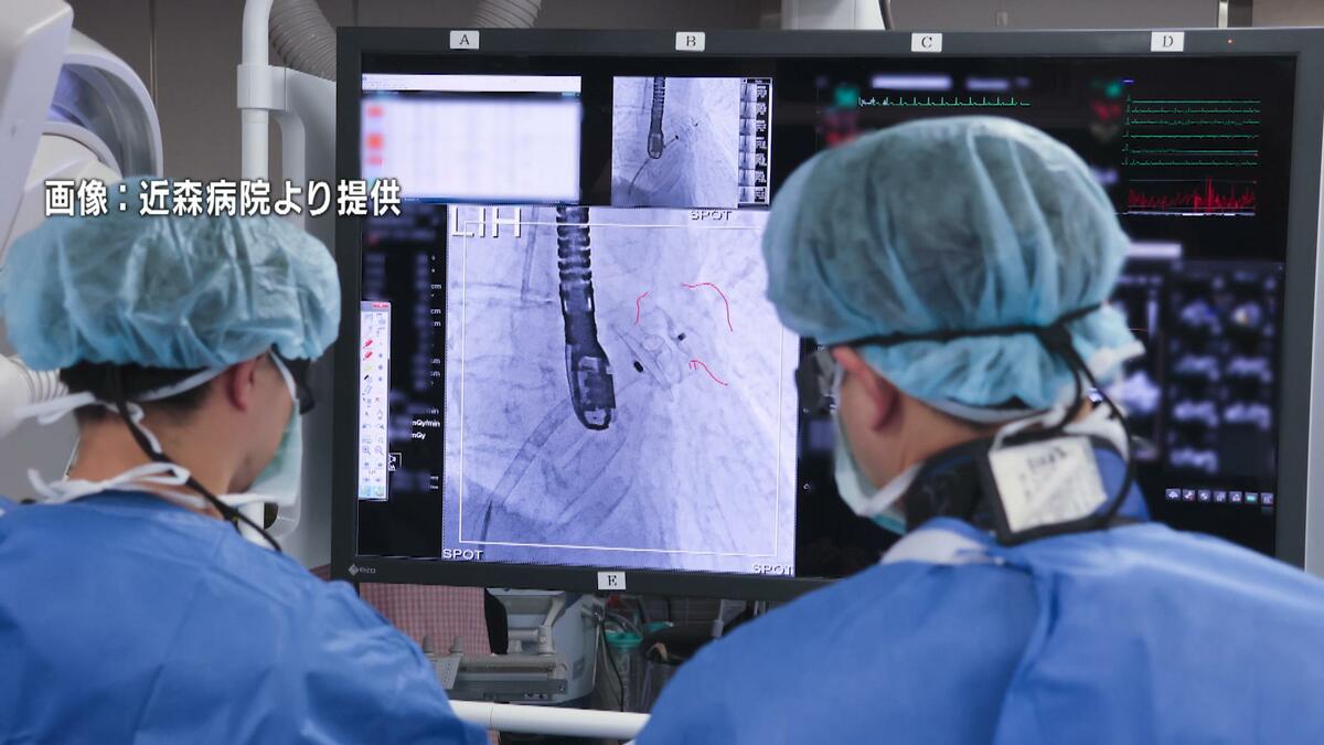 【四国初】脳梗塞の“火種”を封じる「心臓のお守り」近森病院が最新機器アミュレット導入「アクセス悪い高知でも医療完結を」【高知】