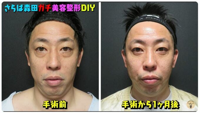 「さらば青春の光」　森田哲矢さん　美容整形手術を受けていたことを報告　昨年末に「もうここで取っちゃおうと」「年末年始はダウンタイムに」|TBS NEWS DIG