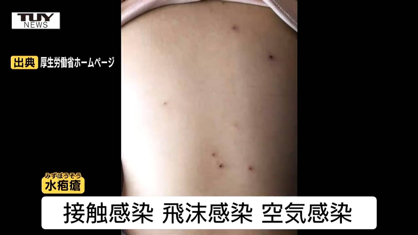 空気感染などでも広がる「水ぼうそう」 村山と最上で警報レベル 県内