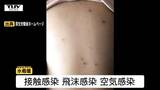 空気感染などでも広がる「水ぼうそう」 村山と最上で警報レベル 県内全体の患者数は減少 乳幼児や成人は重症化リスクも(山形) | 山形のニュース│TUYテレビユー山形