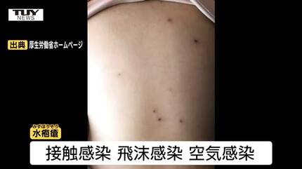 空気感染などでも広がる「水ぼうそう」 村山と最上で警報レベル 県内