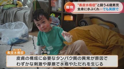 激痛を伴う水ぶくれが全身に… 全国でわずか1000人の難病「表皮水疱症