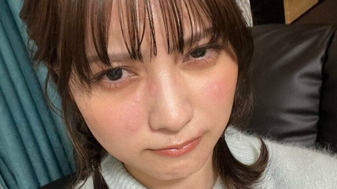 【桃月なしこ】 “顔面湿疹やばくて鬱…蕁麻疹か” 「無加工でこれ」フォロワー気遣い “しっかり病院で診てもらって”|TBS NEWS DIG