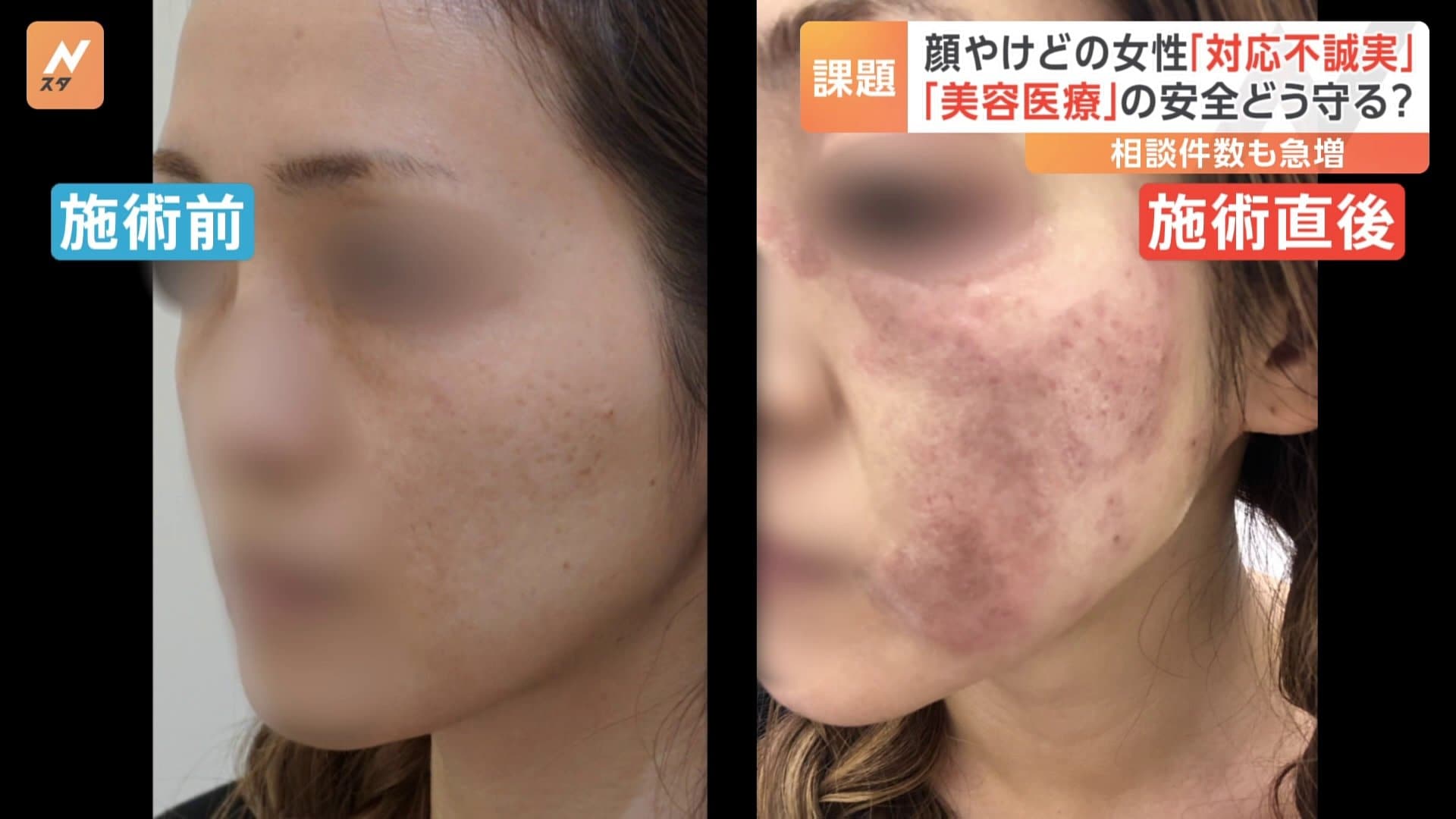 美容医療」の安全どう守る シミ治療でやけども トラブルの背景に経験