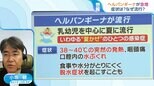 「痛くて食べられない」子どもの“夏かぜ”『ヘルパンギーナ』急増 大人に感染することも…対策を医師に聞く【ひるおび】|TBS NEWS DIG